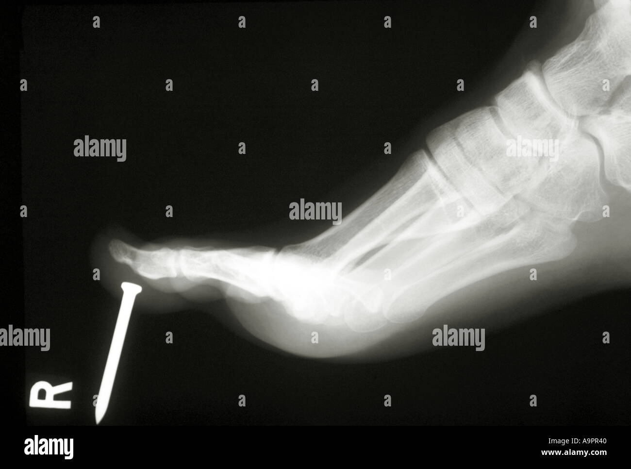 X ray chiodo pregiudizio ai piedi Foto Stock