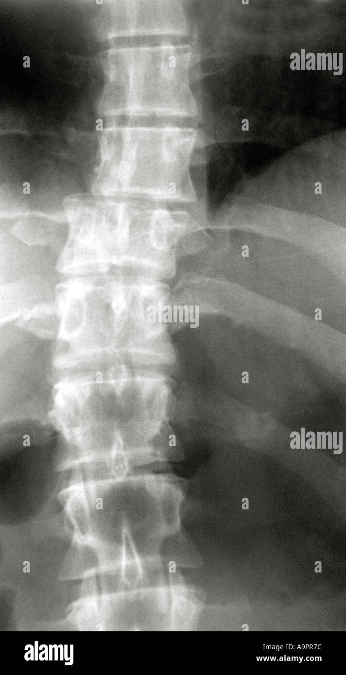 X ray frattura vertebrale Foto Stock