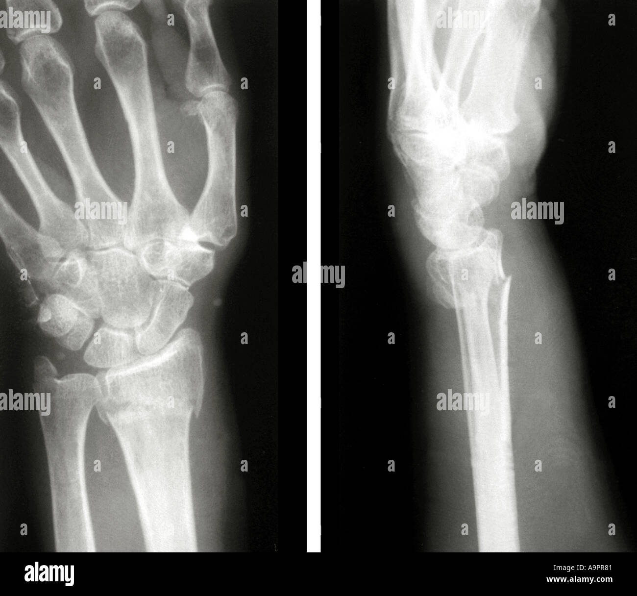 X ray frattura di Colles Foto stock - Alamy