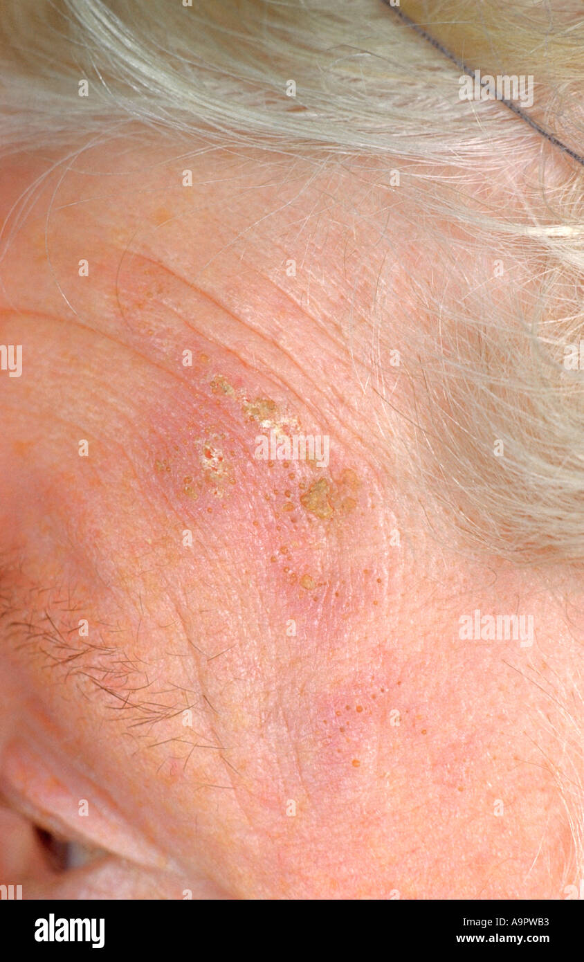 Il keratosis attinico Foto Stock