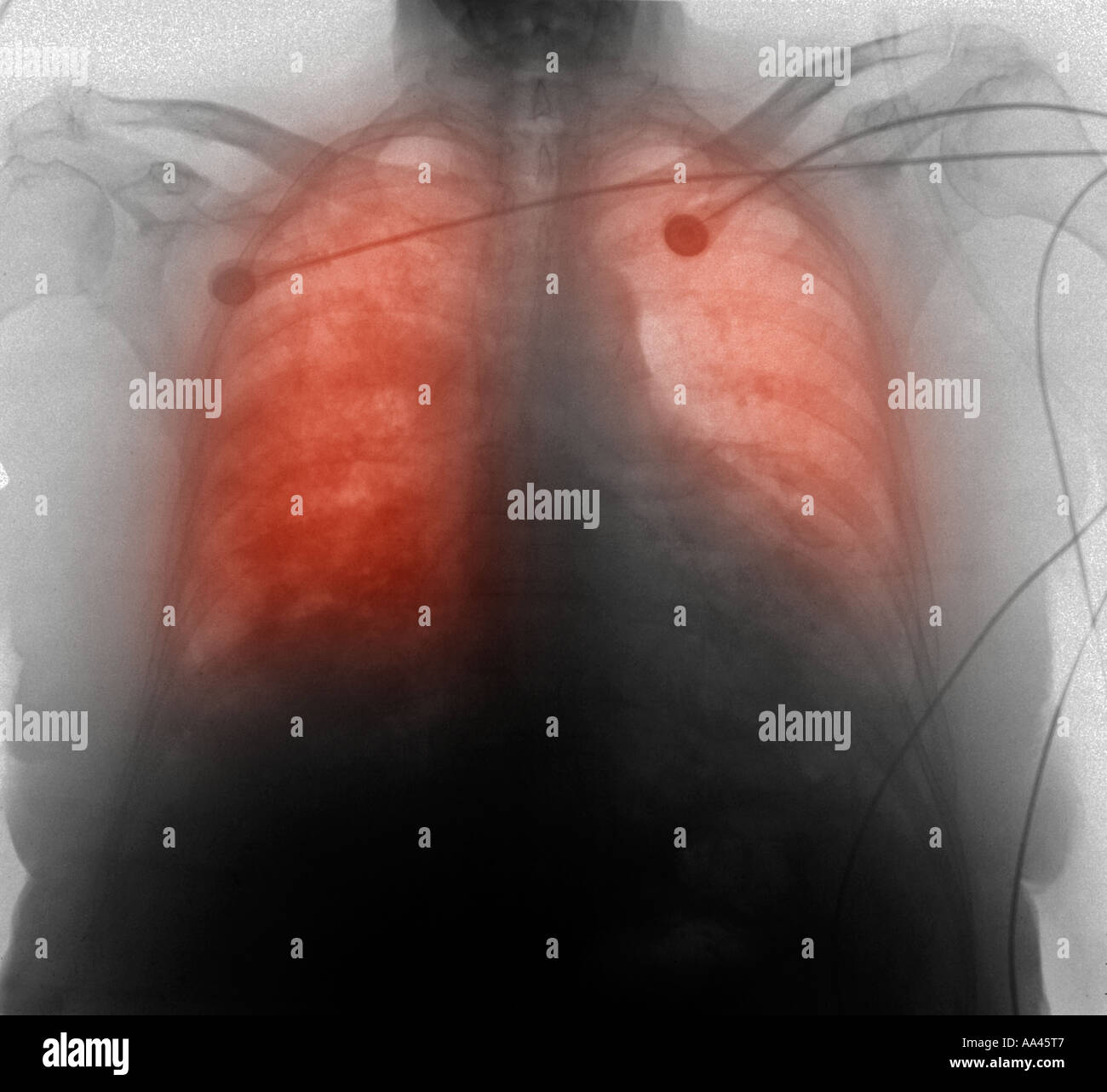 CXR insufficienza cardiaca congestizia 77 anno vecchia donna Foto Stock