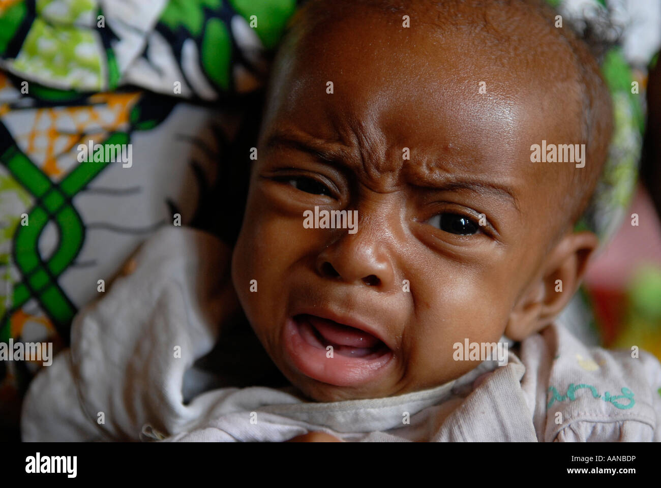 Un bambino malnutrito che piange in un centro medico. Provincia del Nord Kivu, Repubblica Democratica del Congo Africa Foto Stock