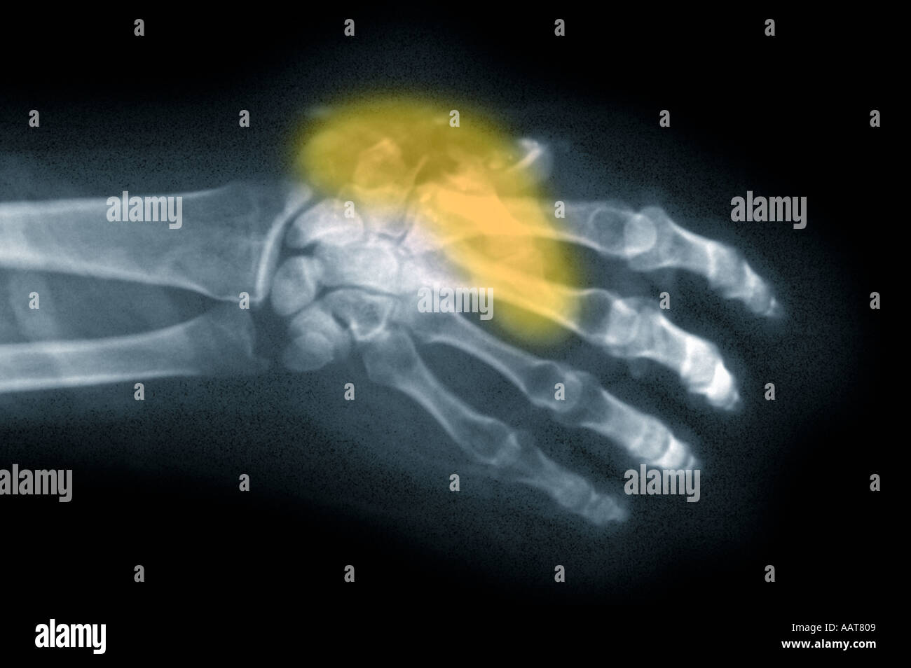 Xray di ferita gunshot a mano con parziale amputazione di pollice Foto Stock