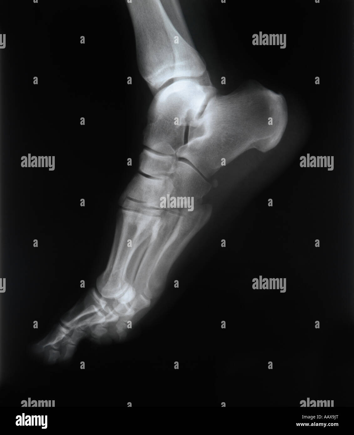 radiografia di un piede Foto Stock