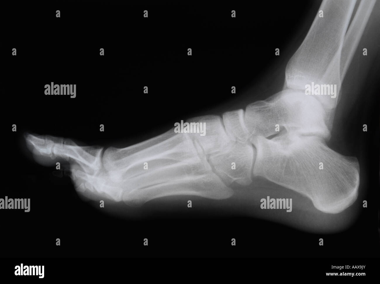 radiografia di un piede Foto Stock