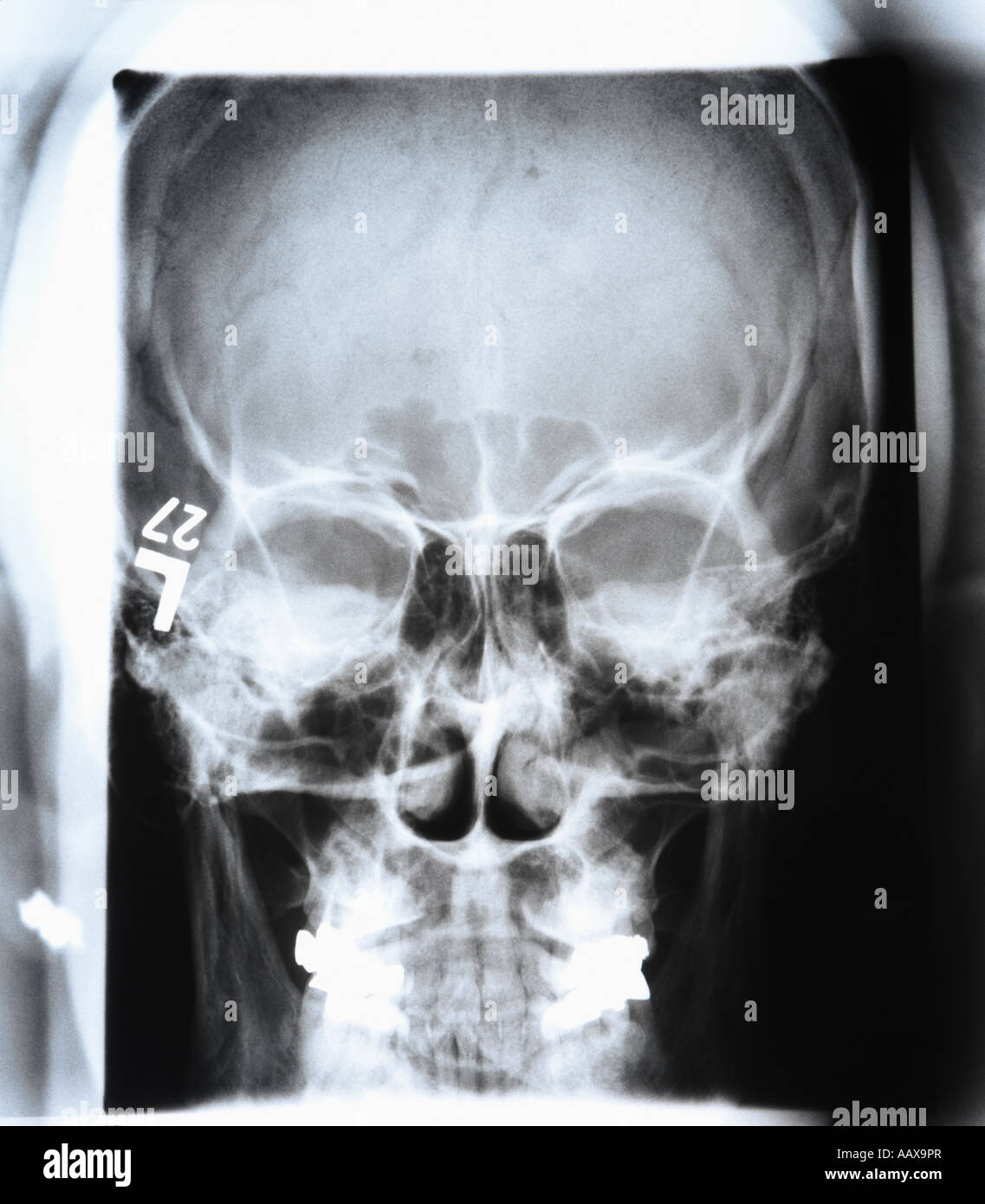 raggi x del cranio Foto Stock