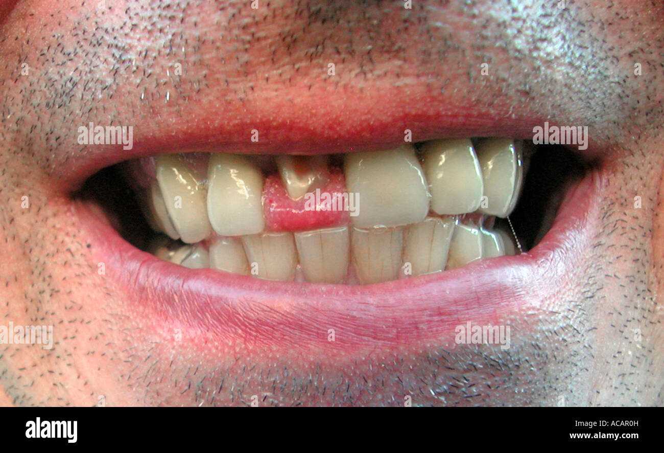 Uomo con un dente rotto di Foto Stock