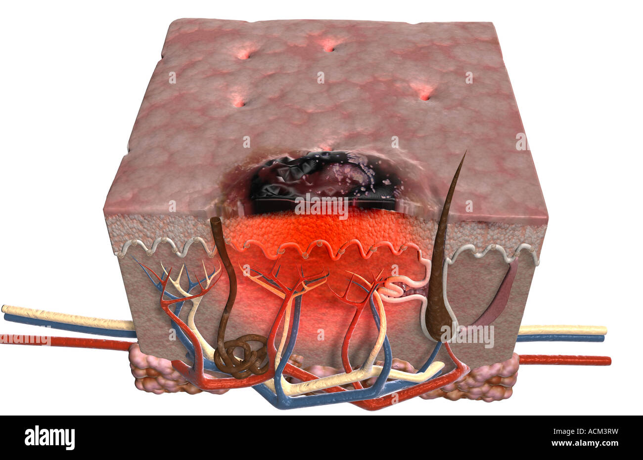 Il melanoma maligno Foto Stock