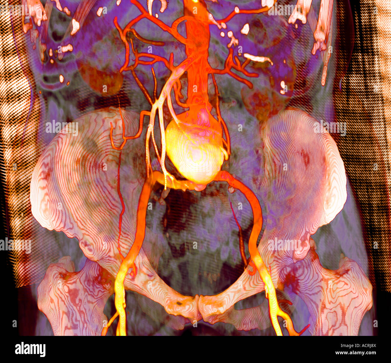 Un grande aneurisma aortico addominale AAA visualizzata da 3D CT scan Foto Stock