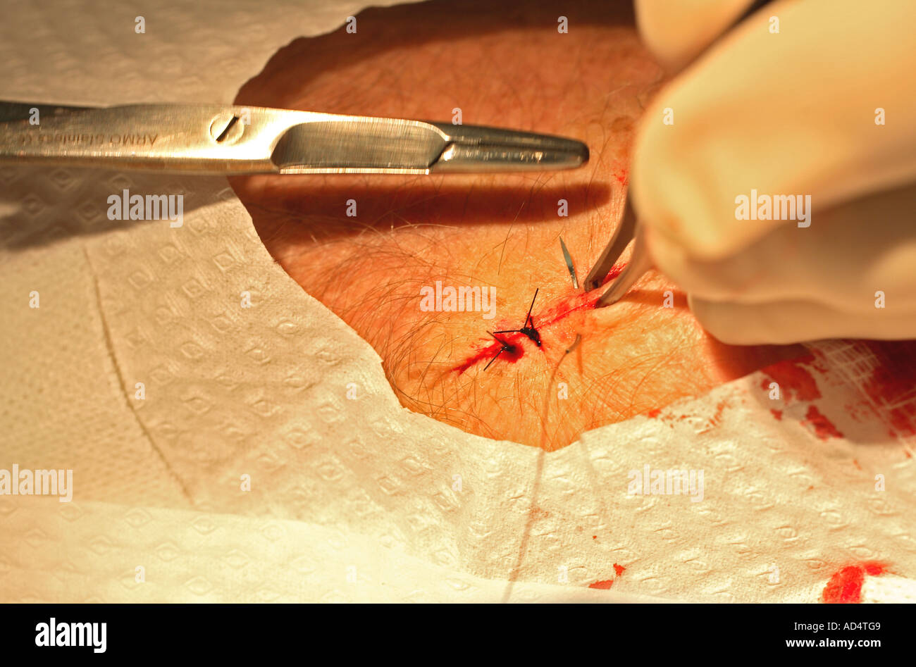 Immissione delle suture o maglie in una ferita dopo la rimozione di un tumore della pelle Foto Stock