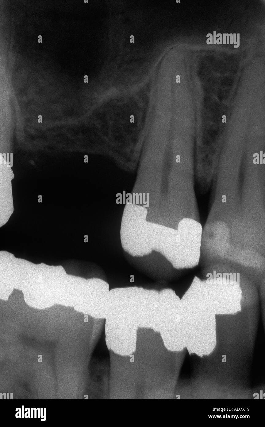 Raggi x dentali Foto Stock