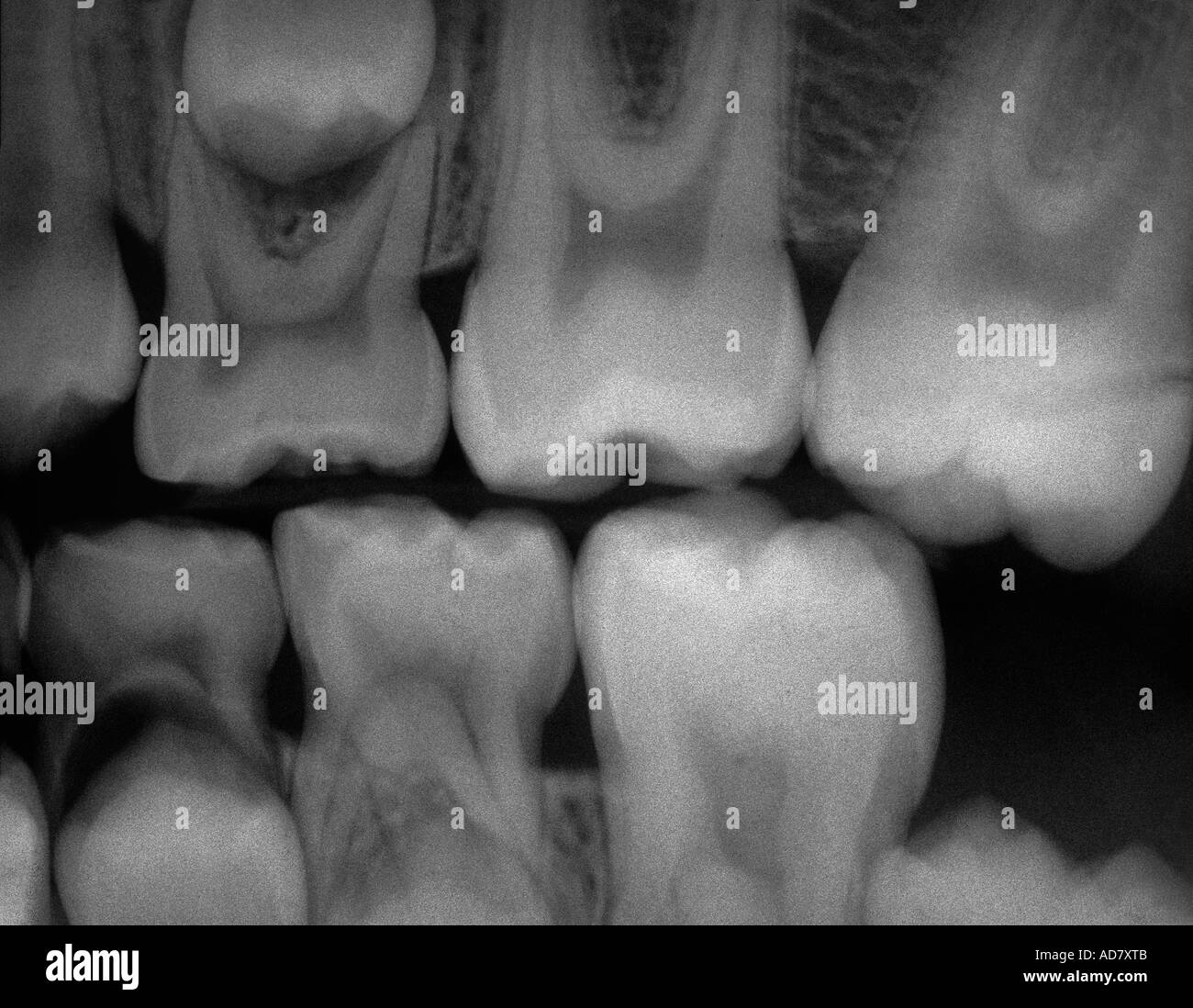 Raggi x dentali Foto Stock