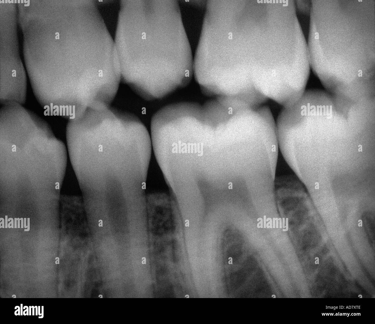 Raggi X dentali Foto Stock