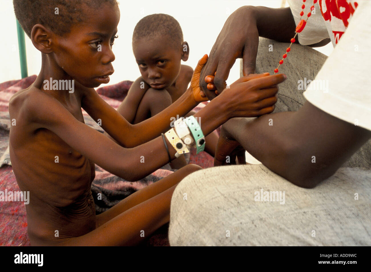 Un bambino malato gioca con un manovale cross. Il medico ritiene che il bambino può essere un bambino di aids. Foto Stock