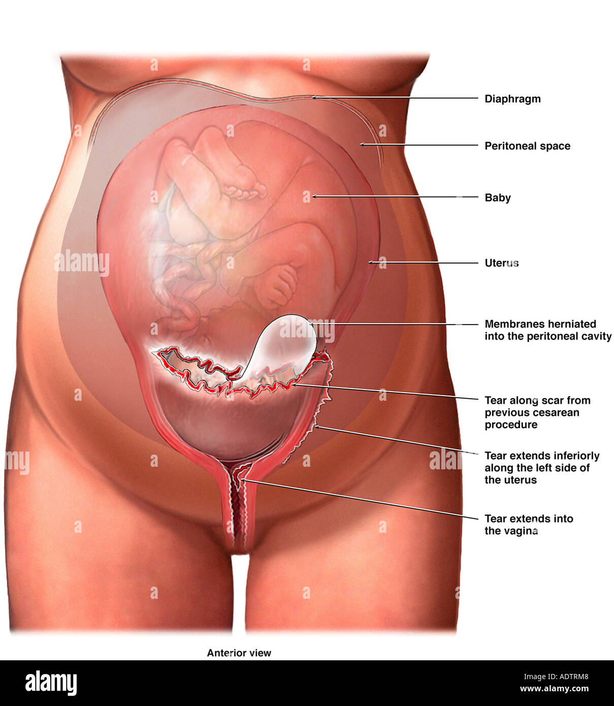 Rottura uterina durante il lavoro Foto Stock