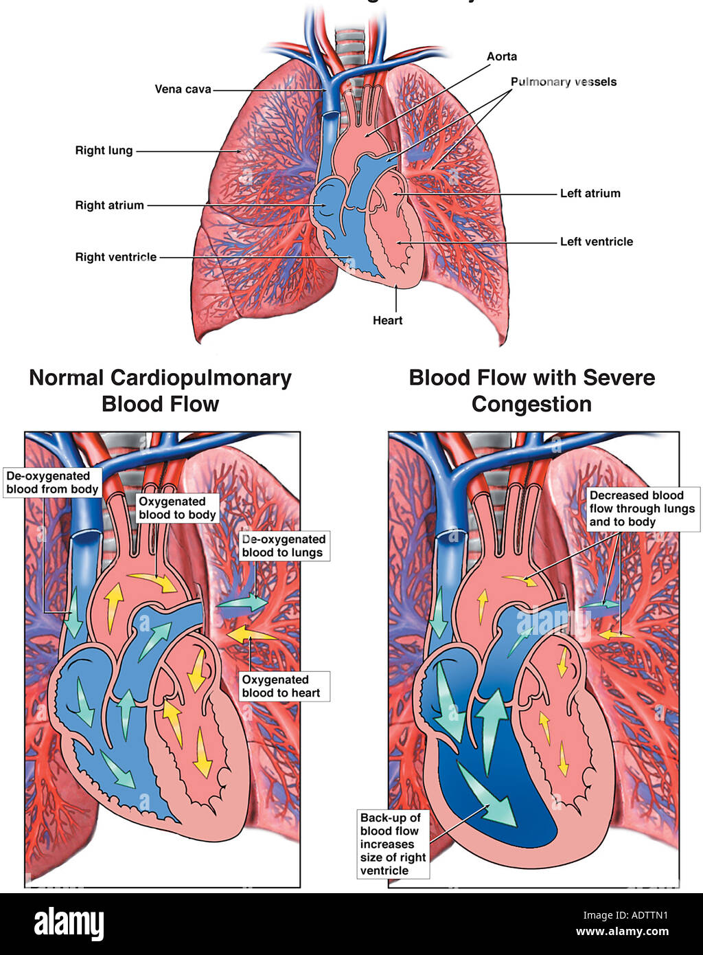 Edema polmonare (congestione polmonare Foto stock Alamy