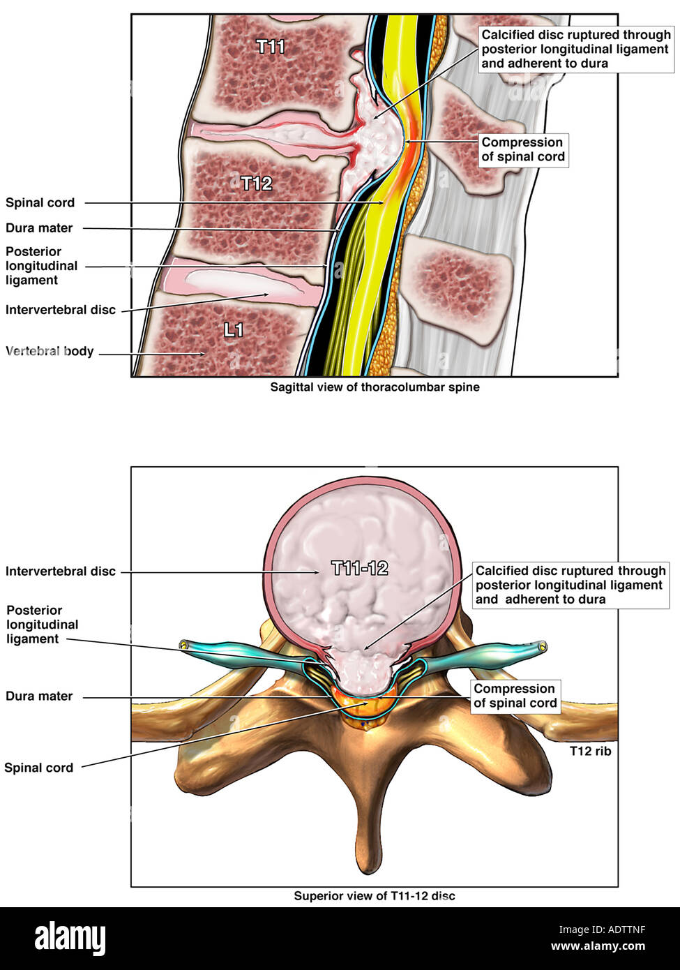 Rottura del T11-12 Disc con grave compressione del midollo spinale Foto Stock