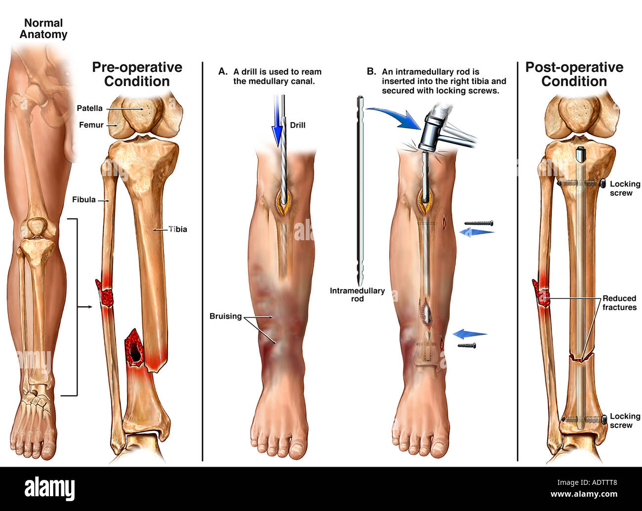 La Parte Inferiore Della Gamba Fratture Rotto Tibia E Perone Con Fissazione Chirurgica Foto Stock Alamy