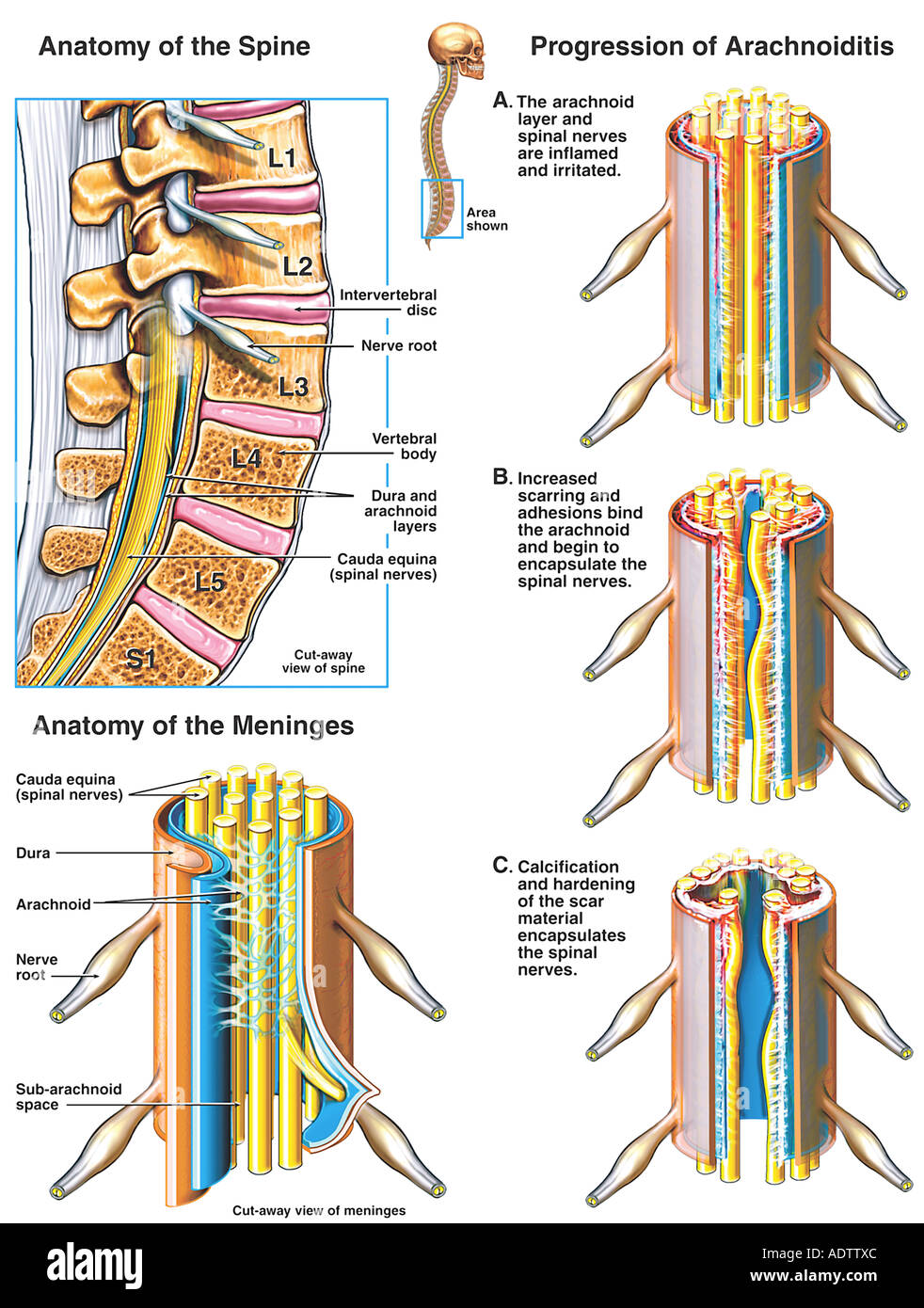 L'aracnoidite del lombo-sacrale della colonna vertebrale Foto Stock