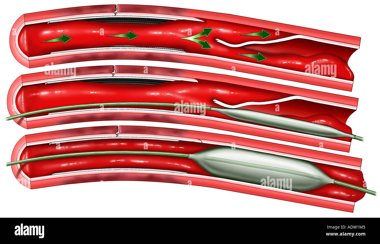 Chirurgia Cardiaca - Bloccate arteria coronaria Serie con angioplastica con palloncino la riparazione Foto Stock