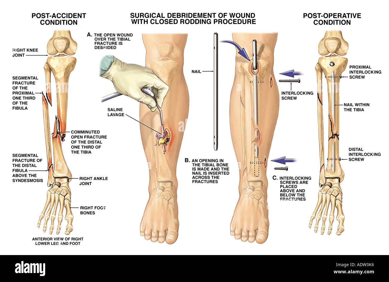 Ossa delle gambe immagini e fotografie stock ad alta risoluzione - Alamy