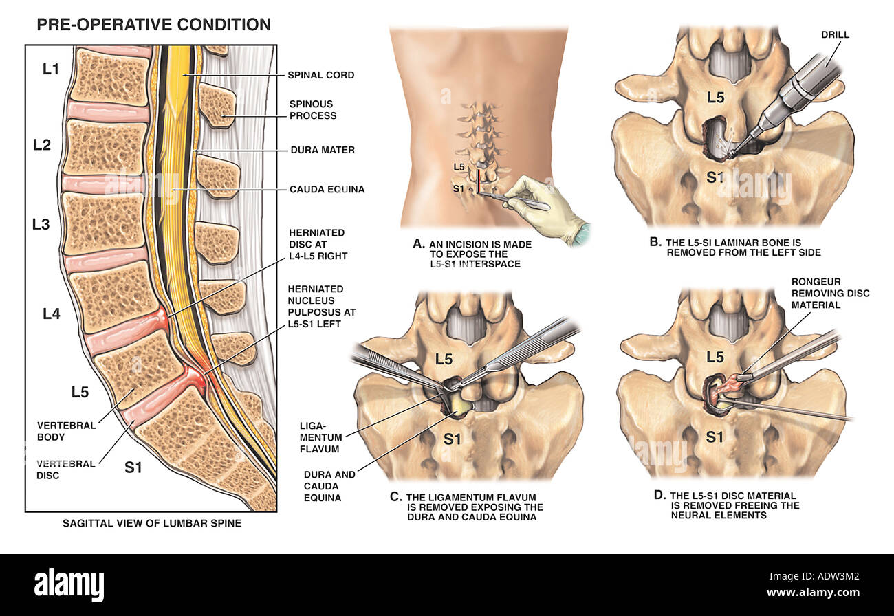 Lumbar Laminectomy Immagini E Fotos Stock Alamy