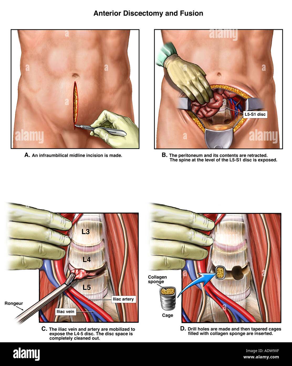 Back Surgery L4 5 lombare fusione spinale Foto Stock