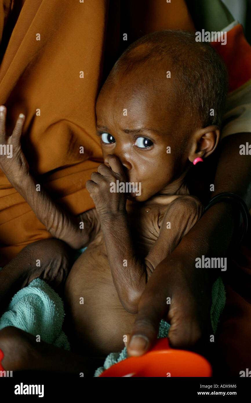 Nel nord della Nigeria vi è elevato livello di malnutrizione grave tra la popolazione Foto Stock
