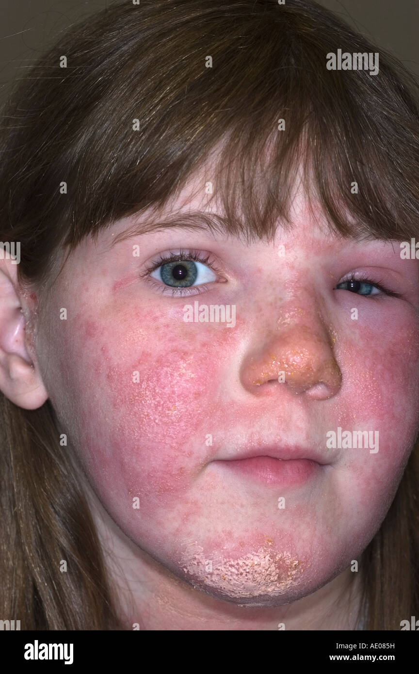 Ragazza giovane con poison ivy rash sul suo viso che lei sta trattando con calamina lozione Foto Stock