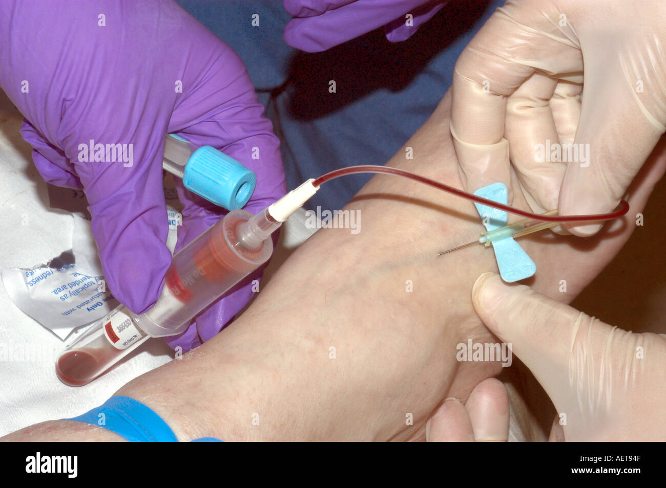 L'infermiere inserisce butterfly catetere in una vena per ottenere campioni di sangue per il test Foto Stock