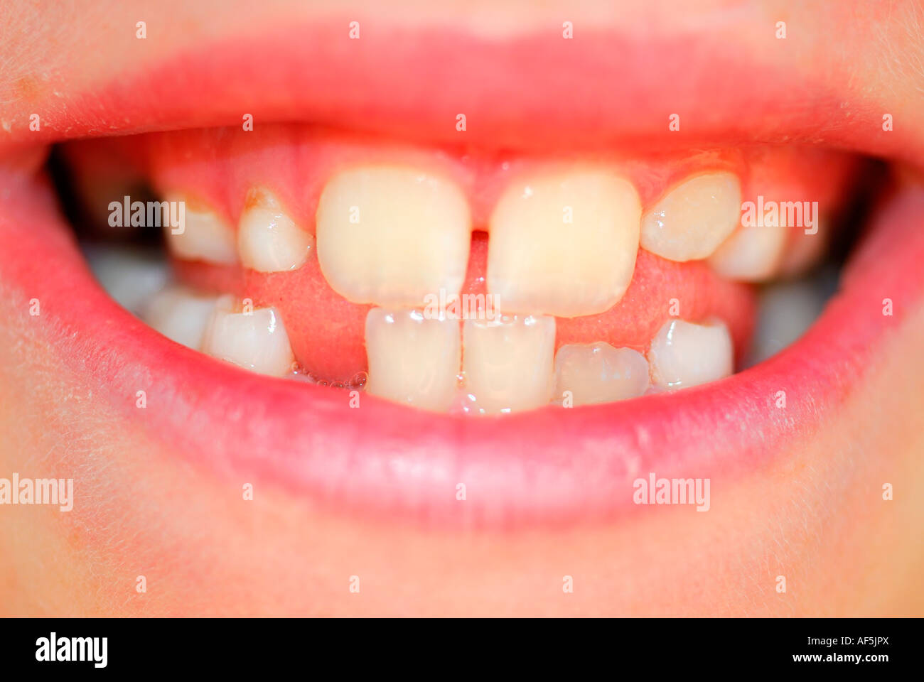 Denti del bambino. Foto Stock