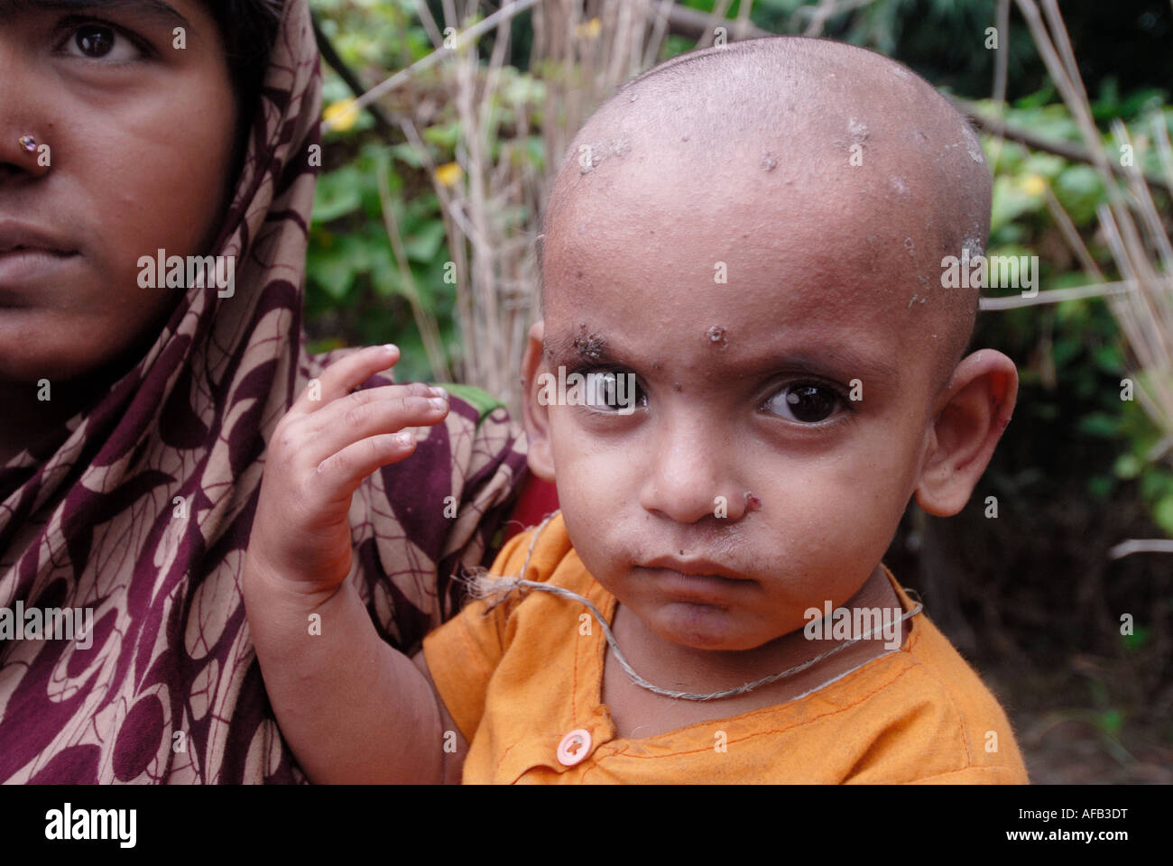 Bangladesh 2007 dopo il diluvio. Shuboh invecchiata 16 mesi che ha una cattiva infezione della pelle da acqua contaminata Foto Stock