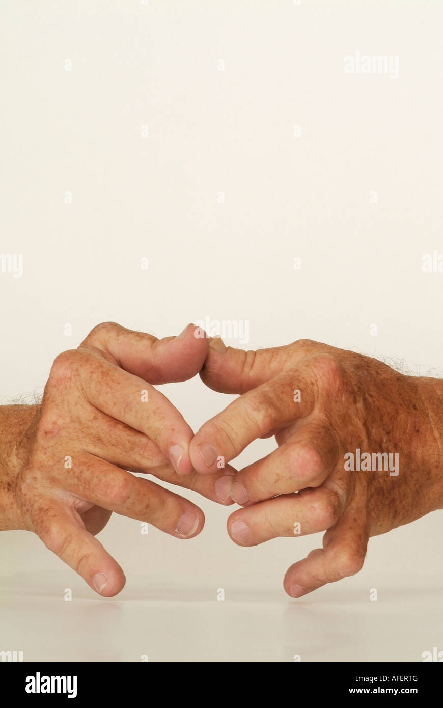 Le mani di un 65 anno vecchio con artrite reumatoide Foto di JBCN Foto Stock