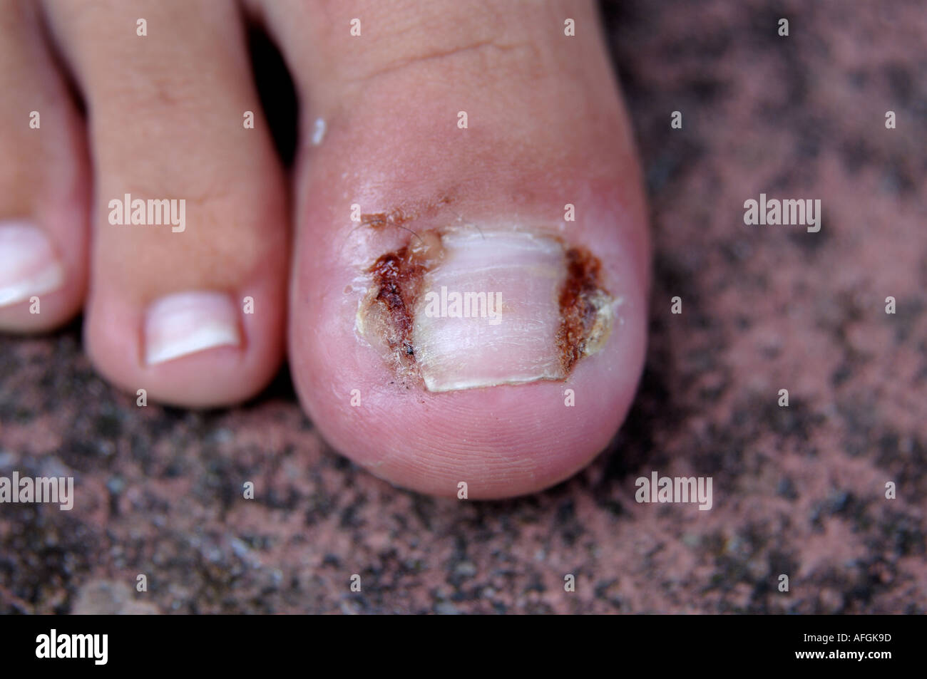 Close up ingrowing toenail che ha girato settico Foto Stock