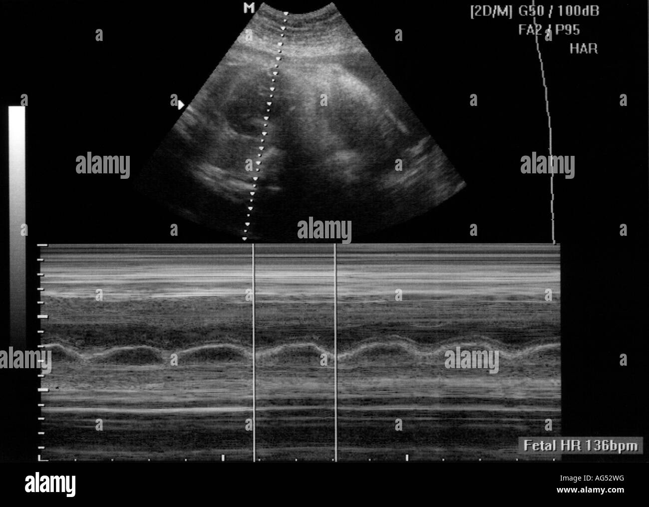 La M mode di misurazione a ultrasuoni di una normale frequenza cardiaca fetale Foto Stock