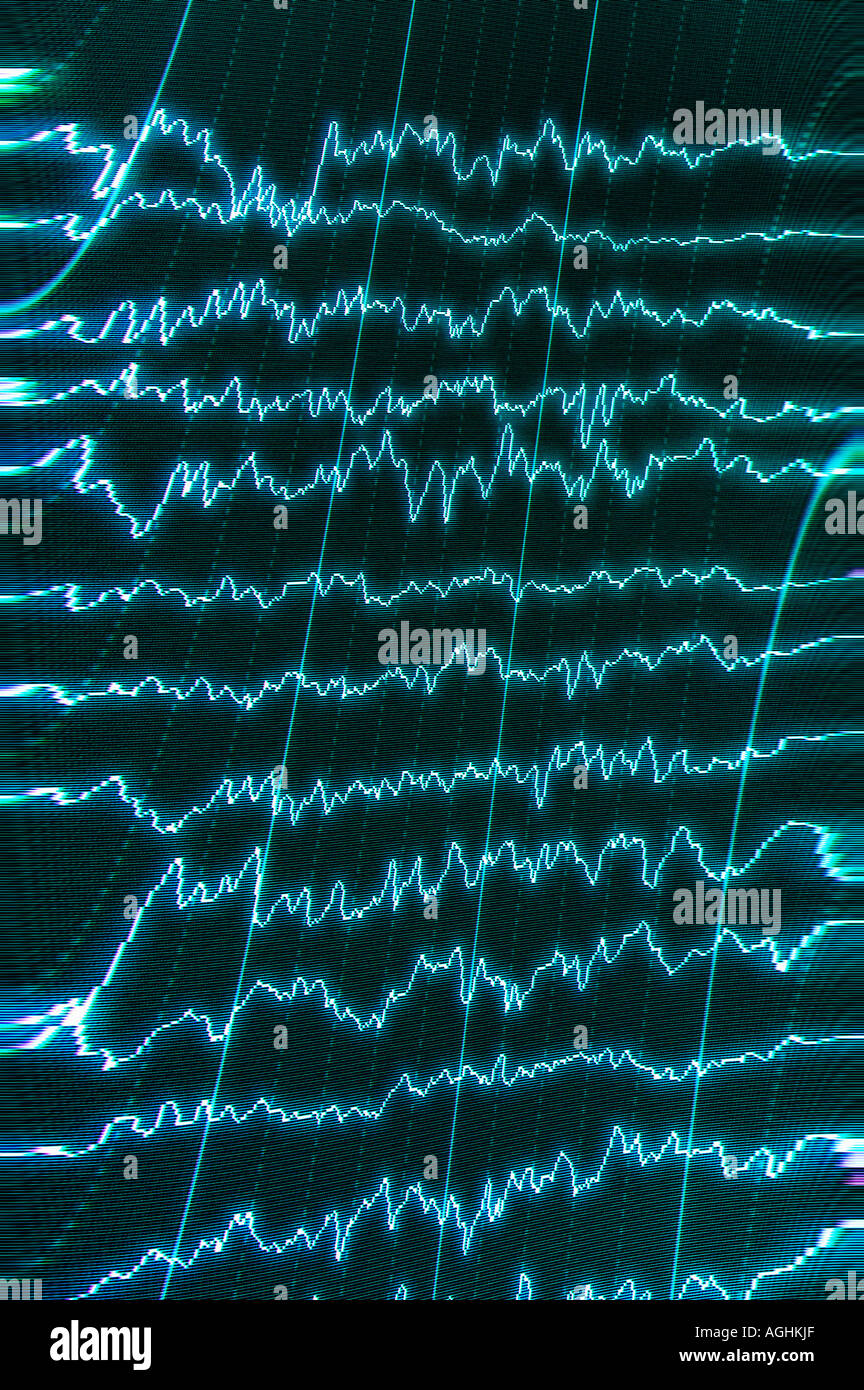 Le onde cerebrali (alfa, beta, gamma) mostra REM-sleep (sognando) Foto Stock