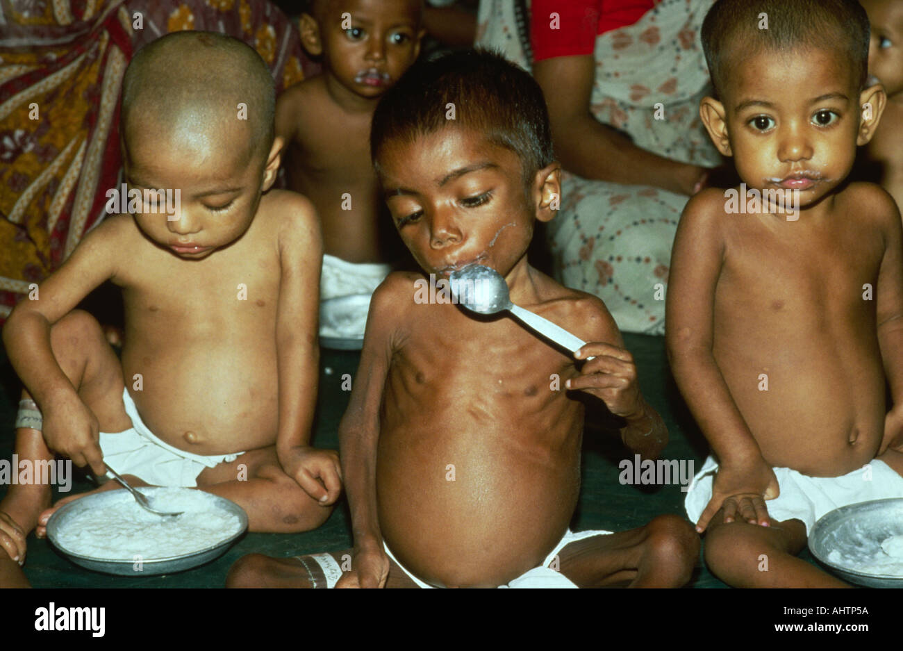 Bambini malnutriti che mangiano cibo ad alto contenuto proteico nell'unità di nutrizione infantile. Dhaka, Bangladesh Foto Stock