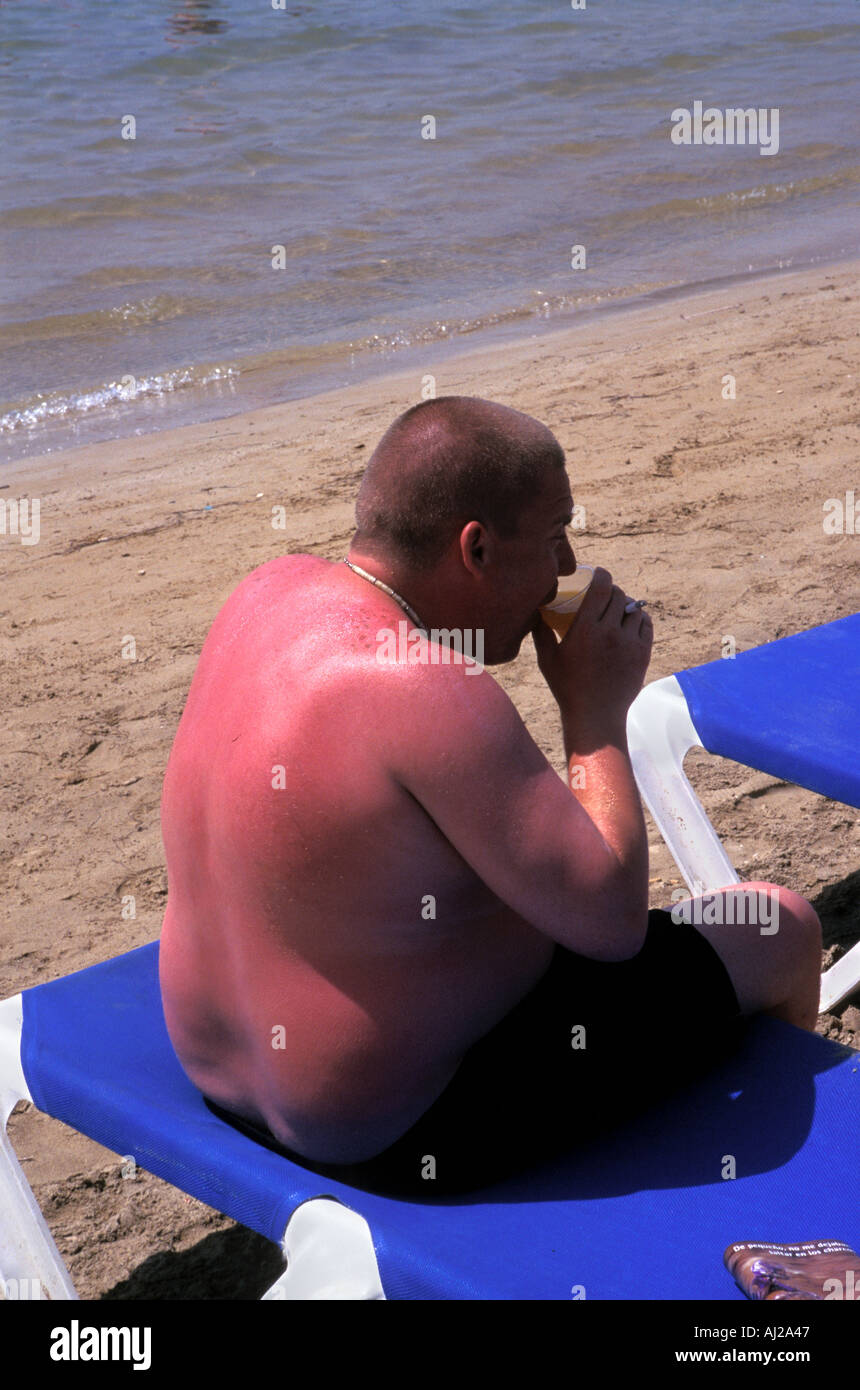 British uomo con scottature seduto sulla spiaggia a Ibiza, Spagna Foto Stock