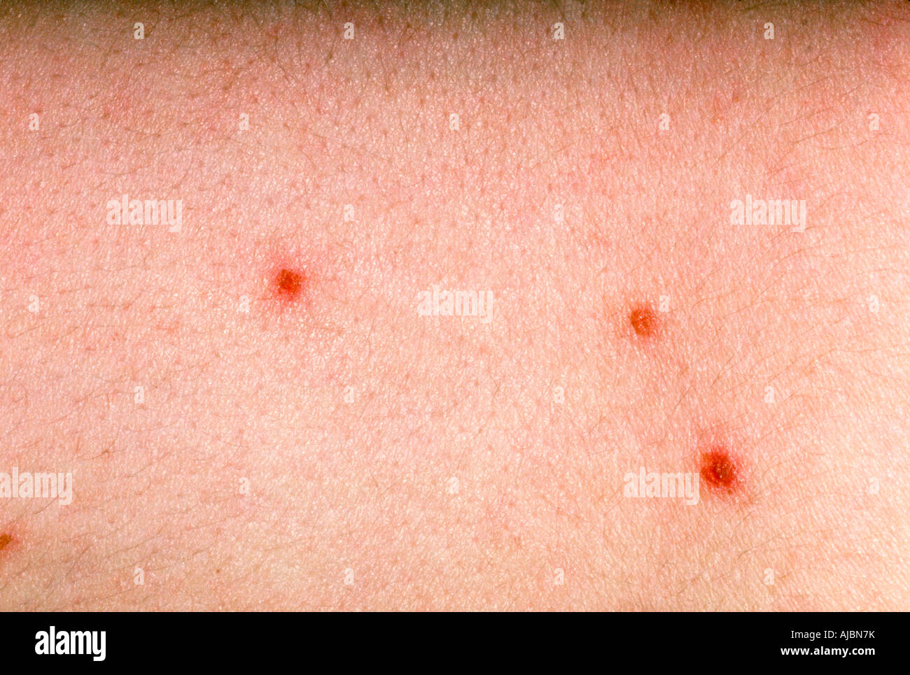 Fotografia di varicella lesioni, una malattia altamente infettiva causata da varicella, un herpesvirus. Foto Stock