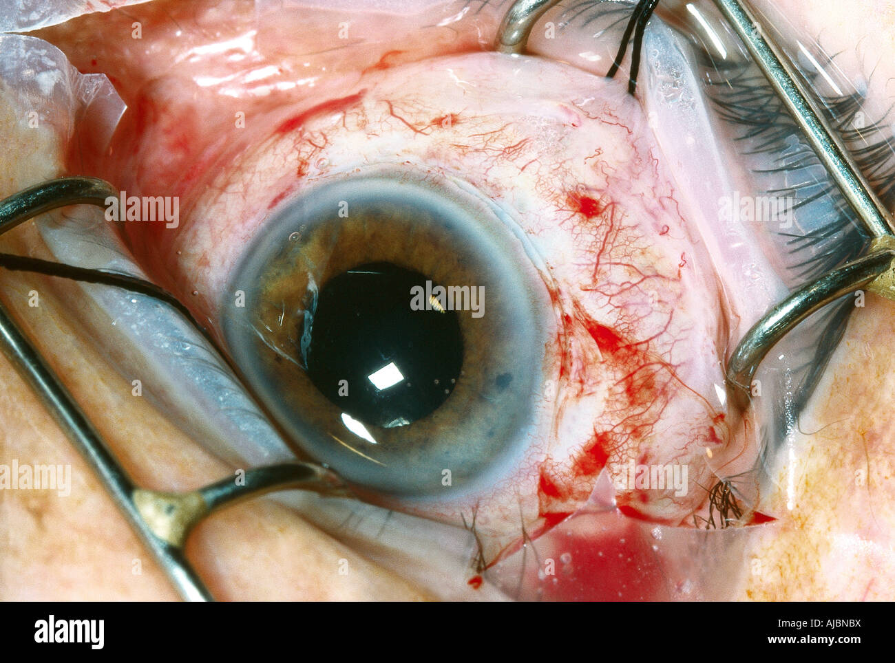 Operazione per inserire un'artificiale di plastica trasparente lente oculare in un paziente con opacità del cristallino dell'occhio Foto Stock