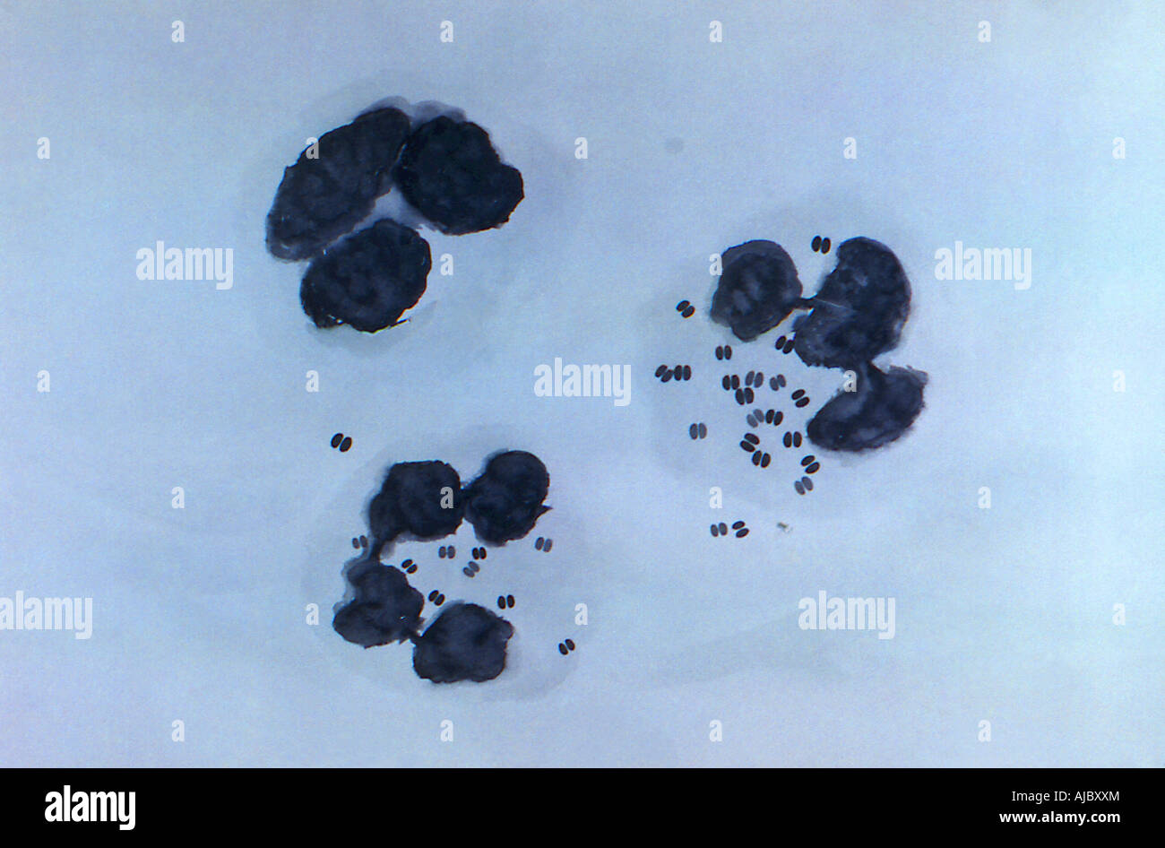 Questa immagine mostra una colorazione di Gram di un essudato uretrale che è diagnostico per da gonococchi uretriti. Foto Stock