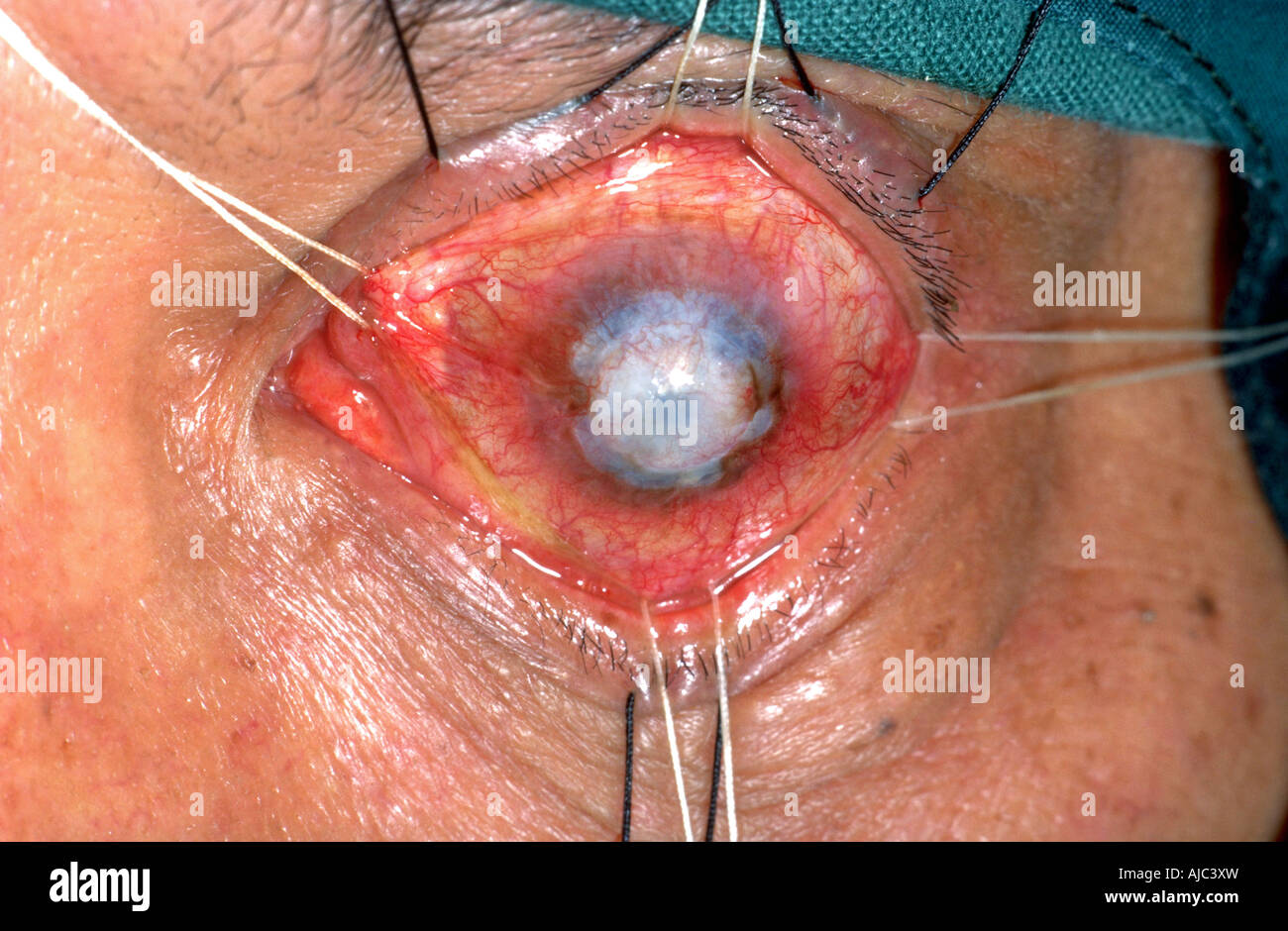 Una immagine fotografica che mostra una chirurgia di cataratta. Foto Stock