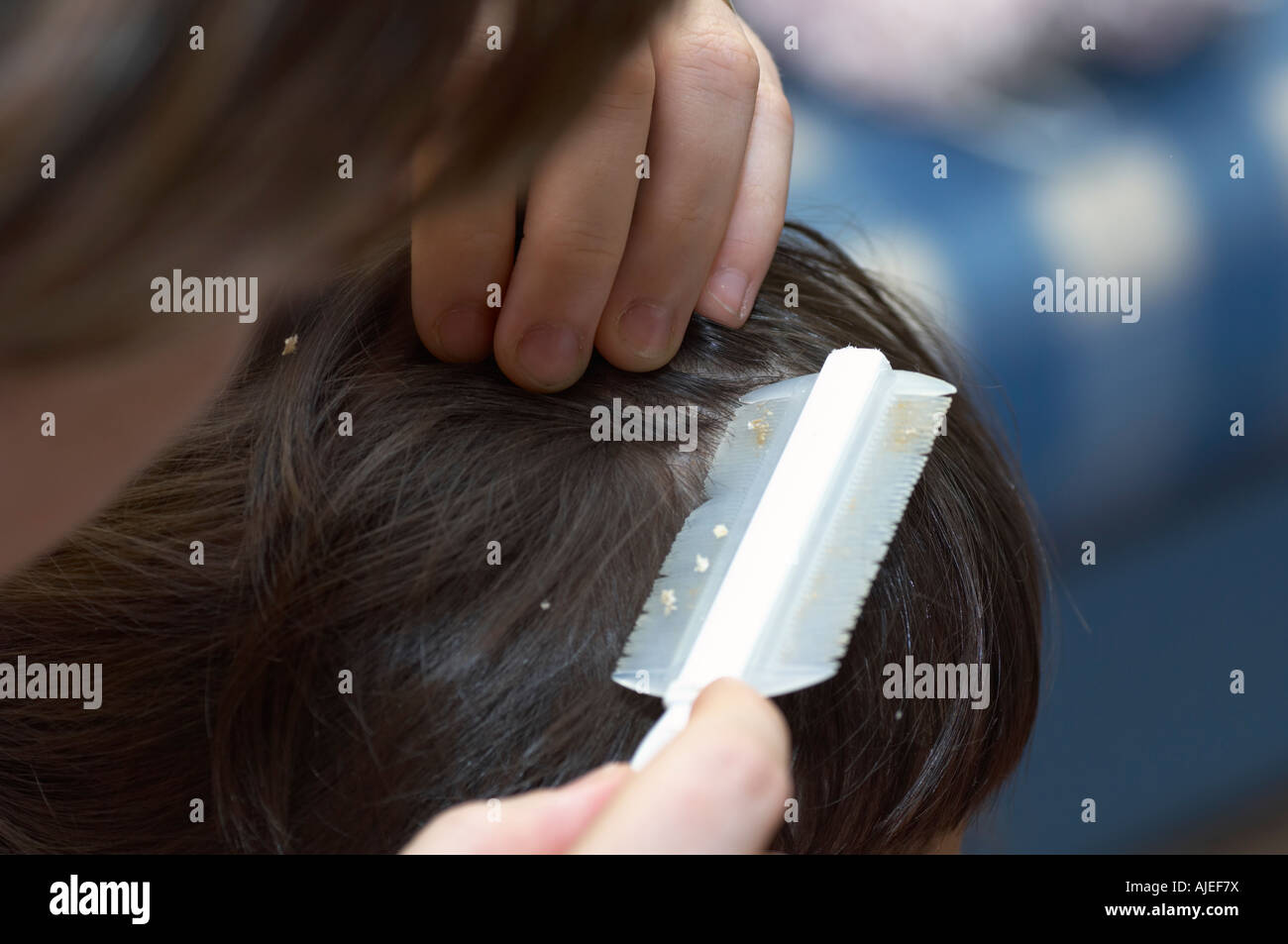 Dermatite seborroica bambino Foto Stock