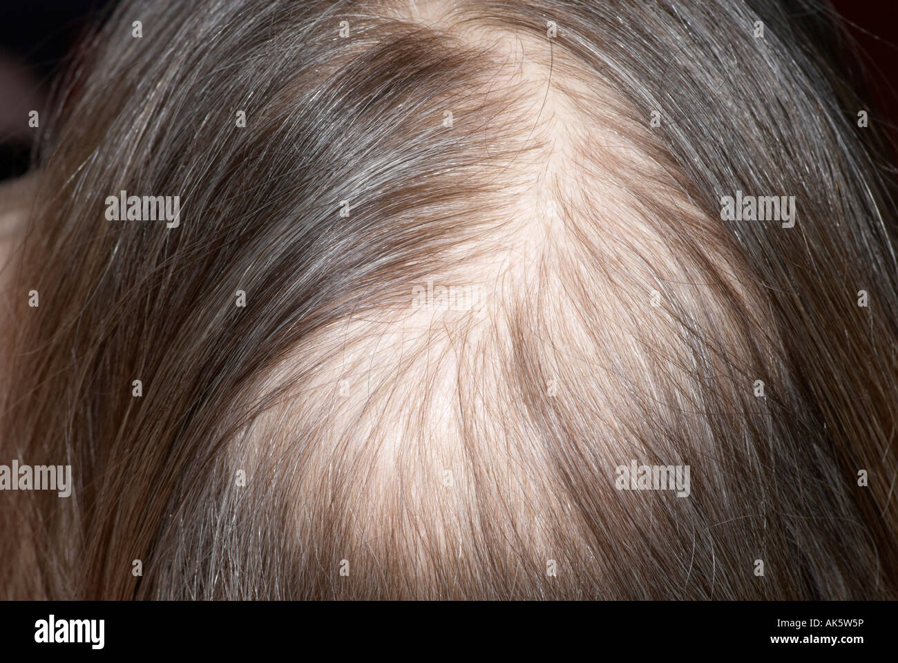 Assottigliamento dei capelli come una conseguenza della chemioterapia con  capelli spazzolato per mostrare la patch Foto stock - Alamy