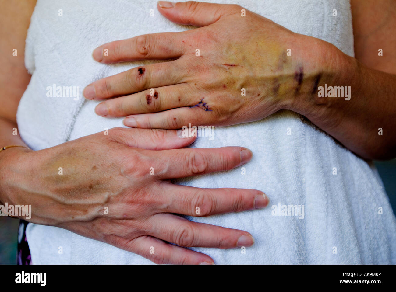 Lesioni a una donna di mano e il braccio Foto Stock