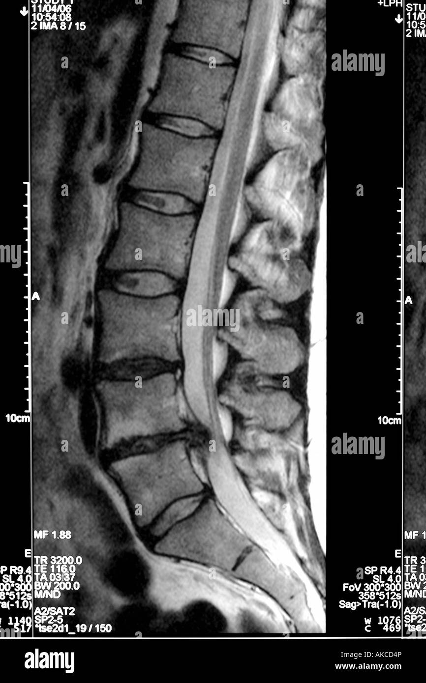 MRI scan che mostra chiaramente un disco scivolato premendo sul midollo spinale e causando dolore severo Foto Stock