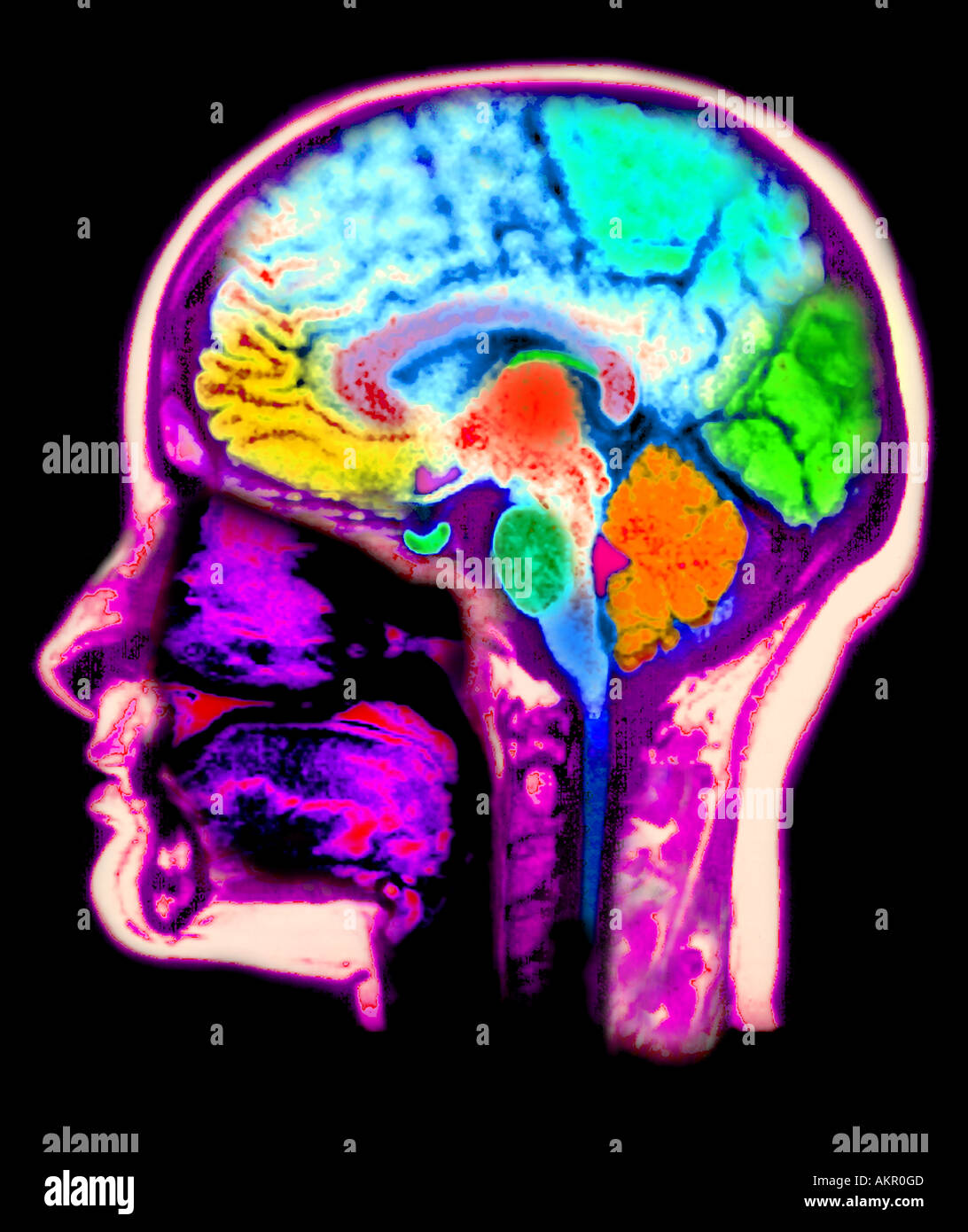 Risonanza magnetica MRI di scansione del computer di testata migliorato e colorato per mostrare la normale anatomia del cervello e la testa Foto Stock