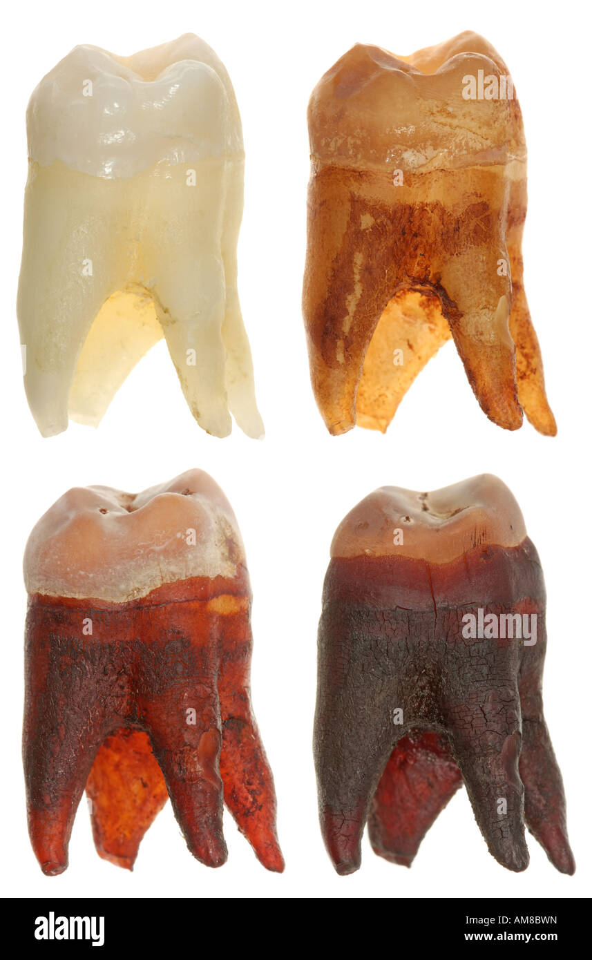 Quattro foto di un dente di saggezza che mostra come si guarda prima e dopo essere imbevuti in una cola per un giorno, una settimana e un mese. Foto Stock
