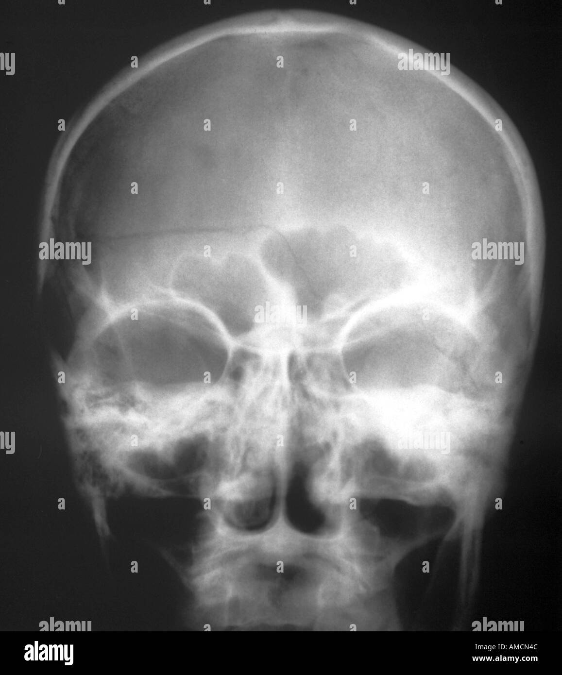 X-ray - cranio fratturato Foto Stock