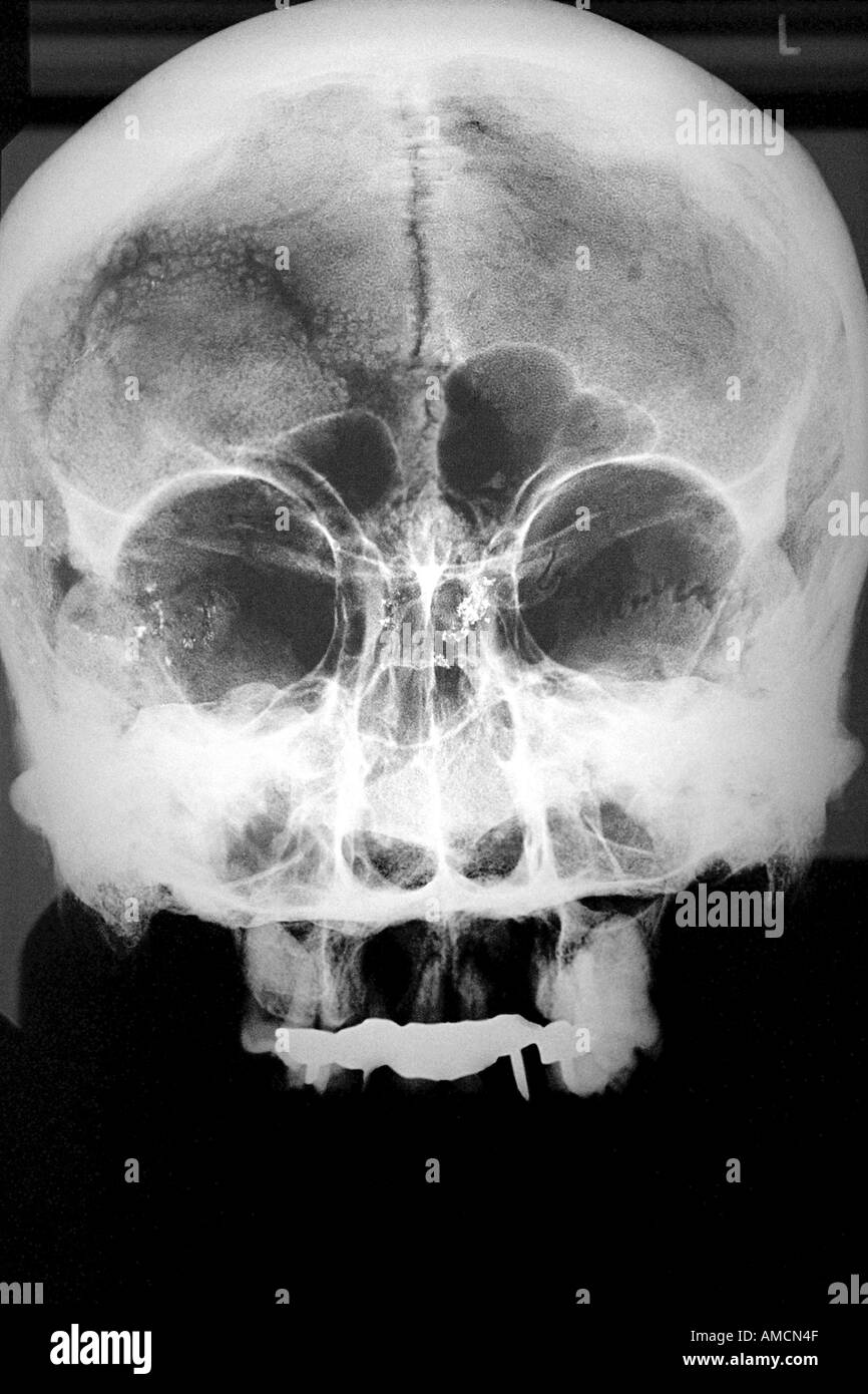 X-ray - suicidio (scatti) Foto Stock